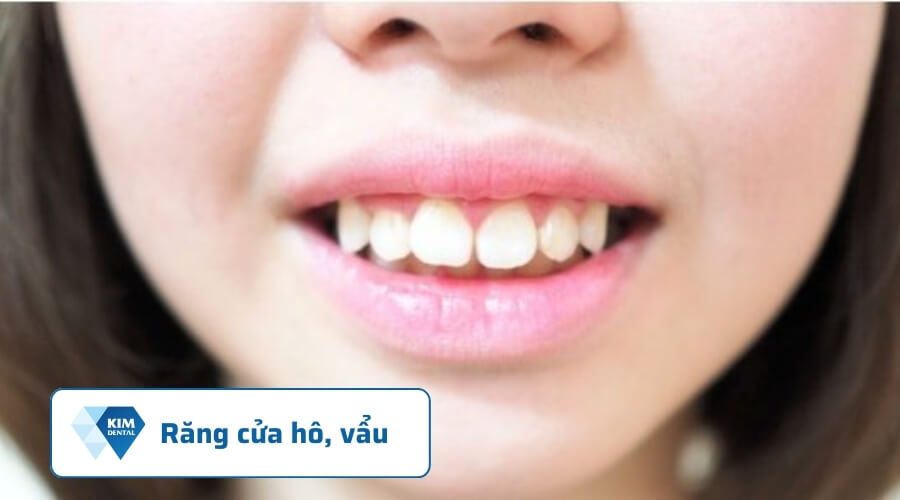 Răng cửa bị hô, vẩu