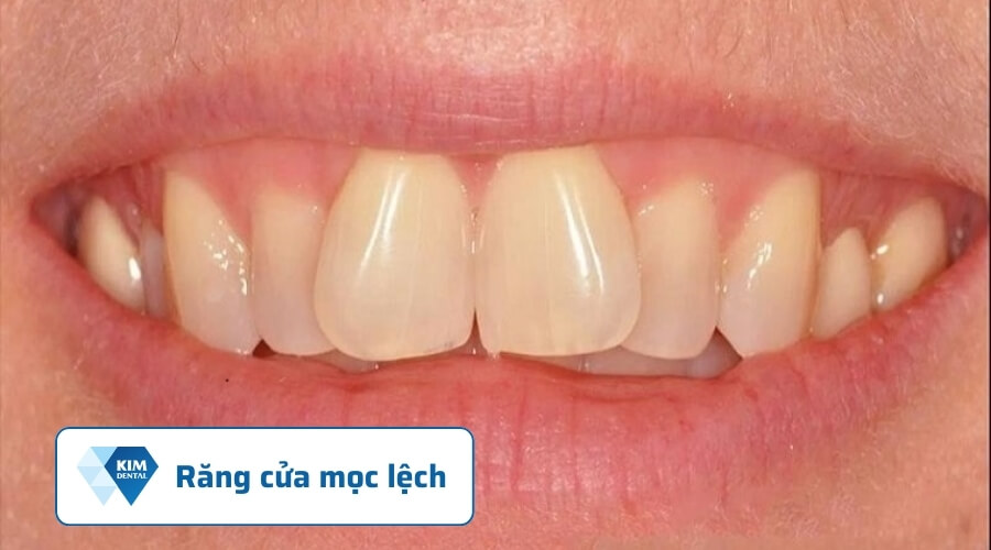 Răng cửa mọc lệch