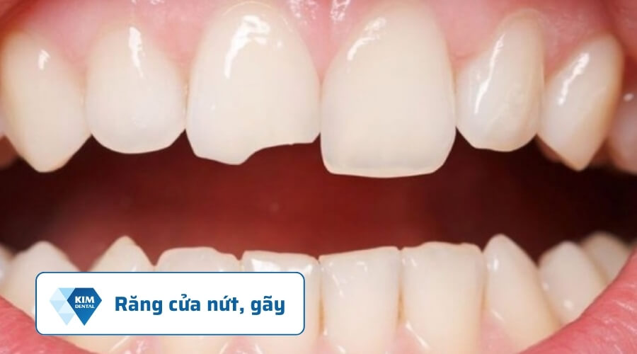 Răng cửa bị nứt, gãy