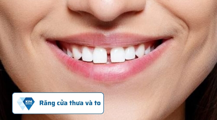 Răng thưa và to