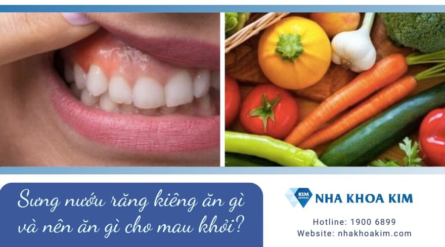 Sưng nướu răng kiêng ăn gì và nên ăn gì cho mau khỏi?