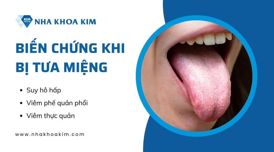 Bệnh tưa miệng có nguy hiểm không?