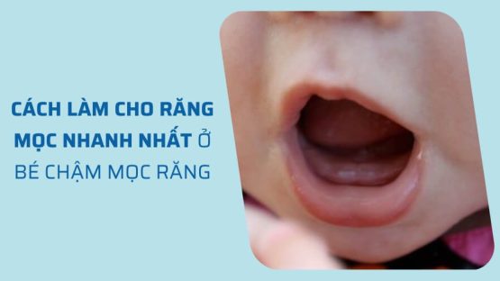 Mẹo cách làm cho răng mọc nhanh nhất ở bé chậm mọc răng