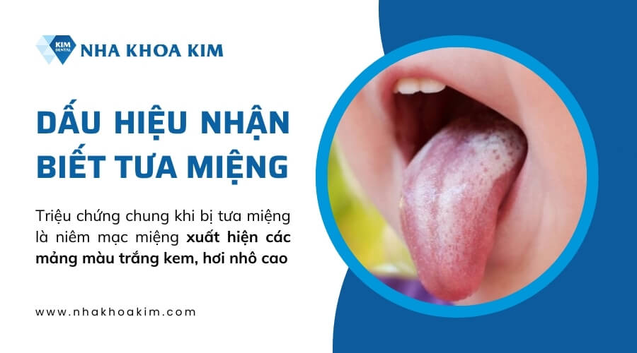 Dấu hiệu bệnh tưa miệng 