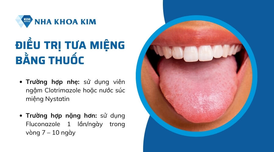 Điều trị bệnh tưa miệng bằng thuốc