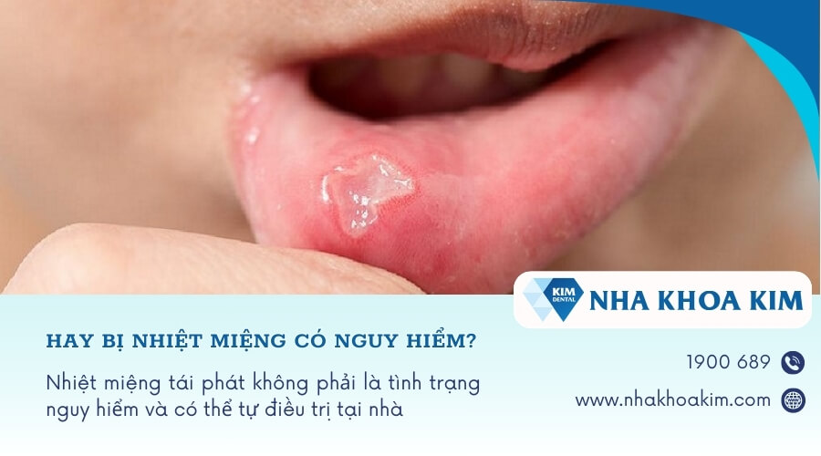 Hay bị nhiệt miệng có nguy hiểm không?