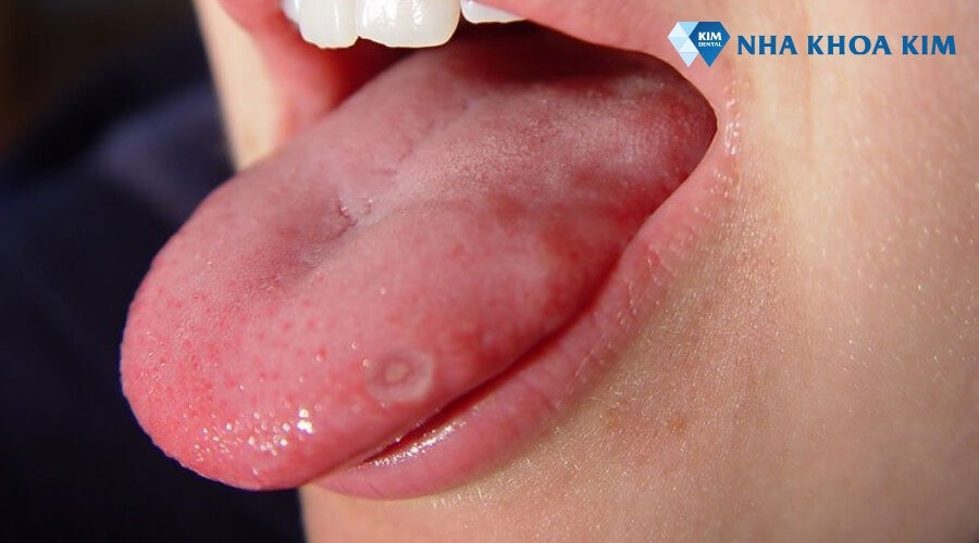 hình ảnh trẻ bị nhiệt lưỡi