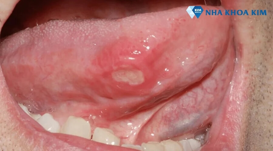 hình ảnh nhiệt miệng ở lưỡi