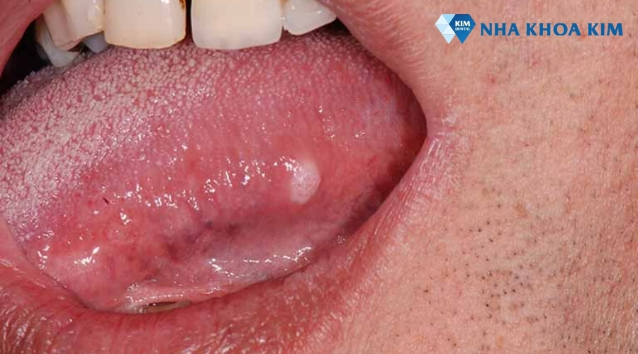 hình ảnh bị nhiệt lưỡi