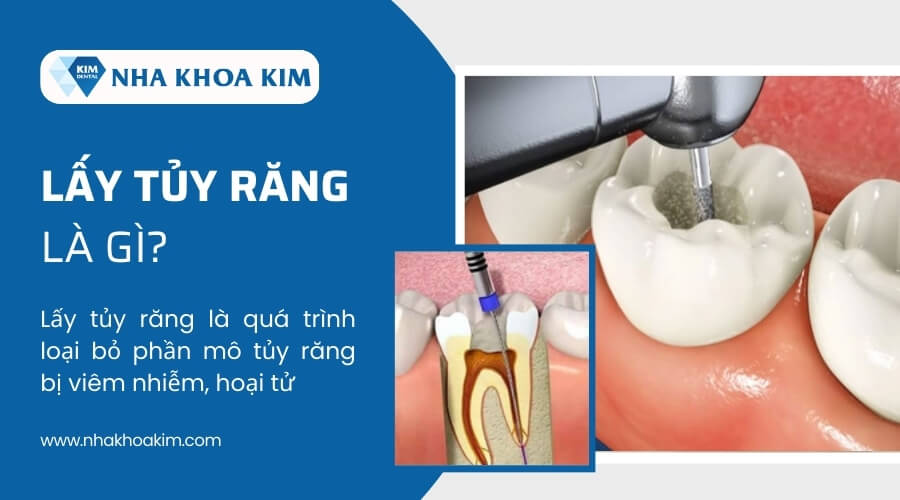 Lấy tủy răng là gì?