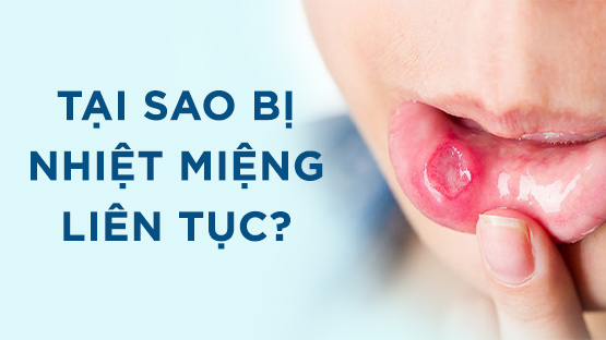 Tại sao bị nhiệt miệng liên tục, tái đi tái lại nhiều lần?