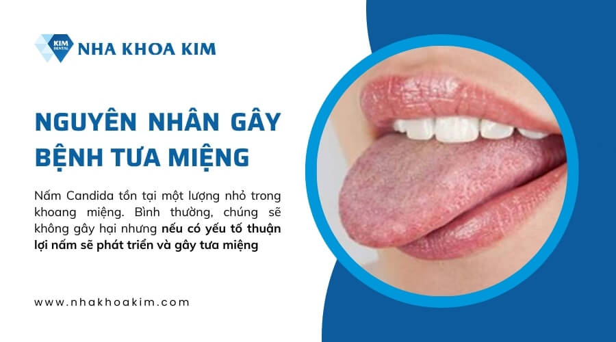 Nguyên nhân gây bệnh tưa miệng