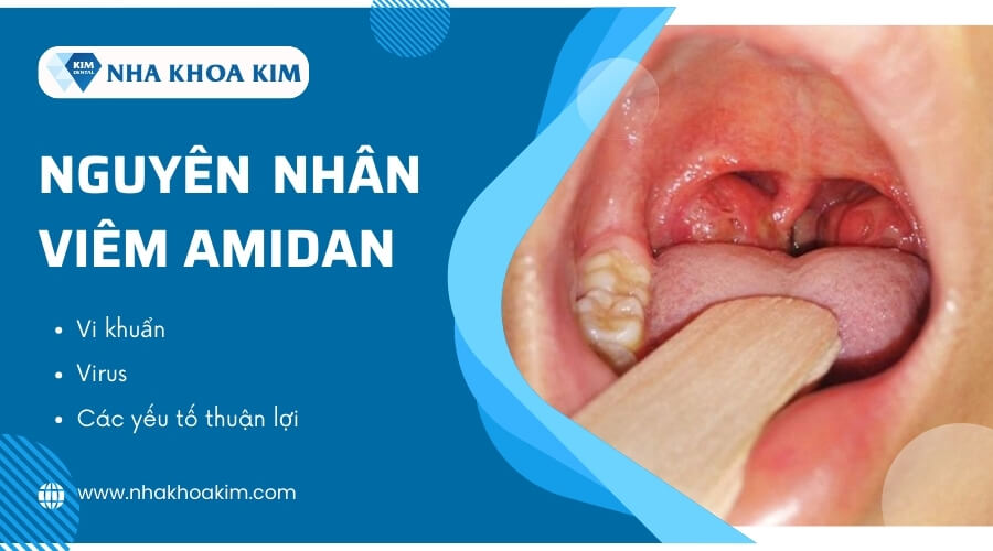 Nguyên nhân gây bệnh viêm amidan