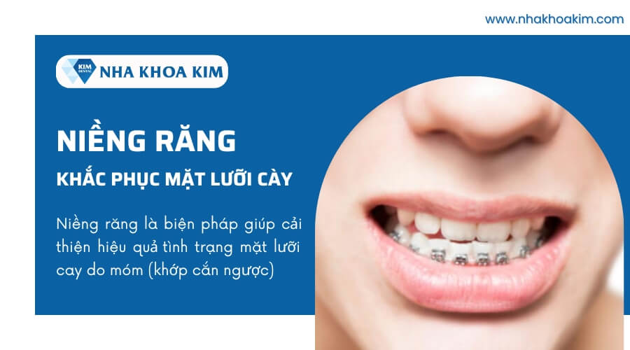 Niềng răng khắc phục tình trạng mặt lưỡi cày