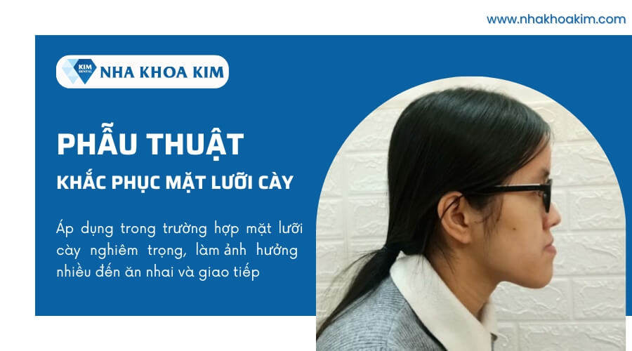 Phẫu thuật thẩm mỹ khắc phục tình trạng mặt lưỡi cày