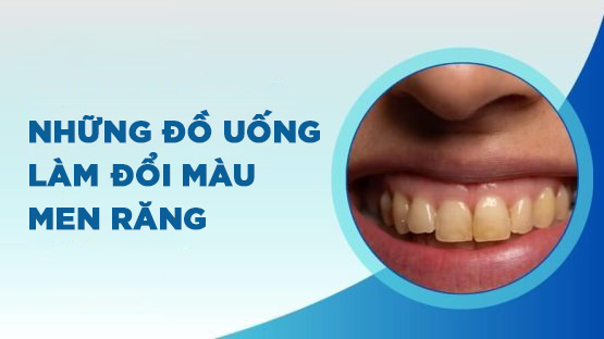 Răng ố vàng là bệnh gì? Nguyên nhân gây vàng răng