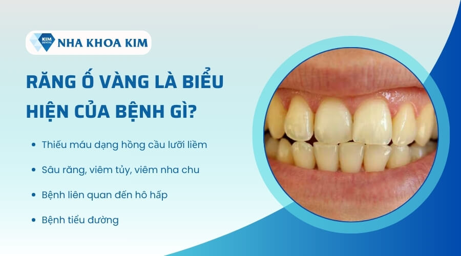 Răng ố vàng là biểu hiện của bệnh gì?