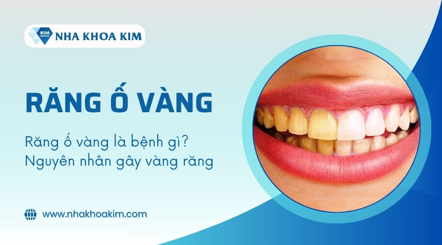 Răng bị ố vàng do ăn nhiều thực phẩm có chứa màu