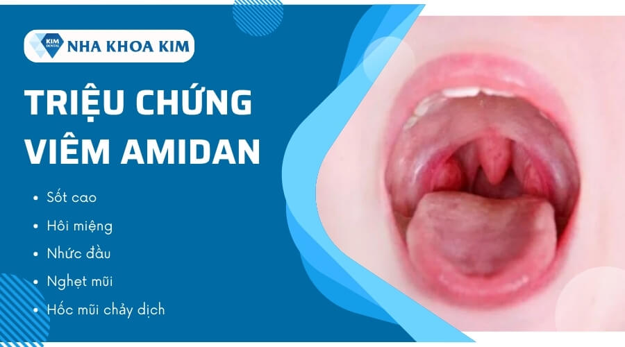 Triệu chứng viêm Amidan