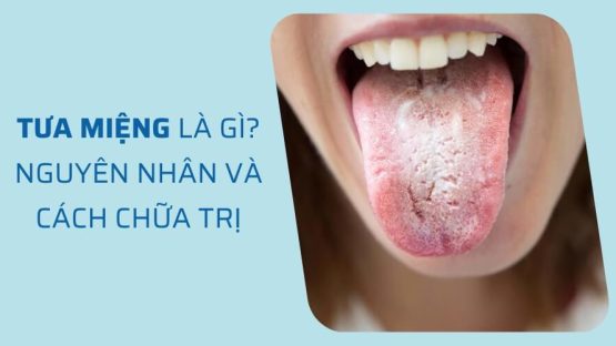 Tưa miệng là gì? Nguyên nhân và cách chữa trị