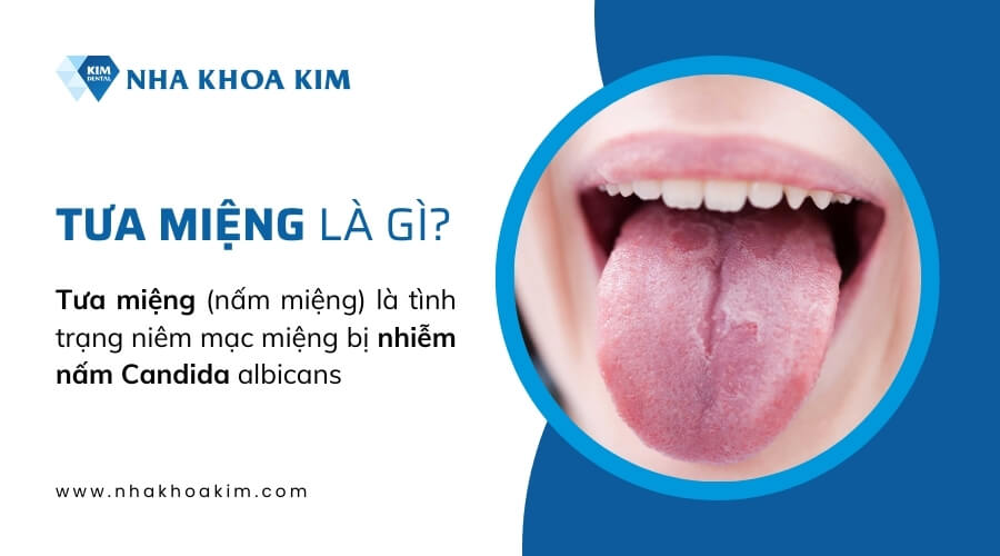 Tưa miệng là gì?