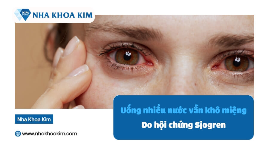 uống nhiều nước nhưng vẫn khô miệng do hội chứng sjoogren