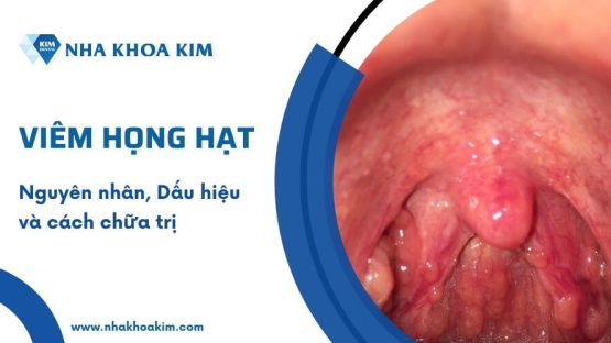 Viêm họng hạt: Nguyên nhân, Dấu hiệu và cách chữa trị