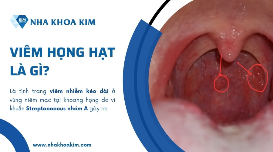 4. Lưu ý khi điều trị viêm họng hạt