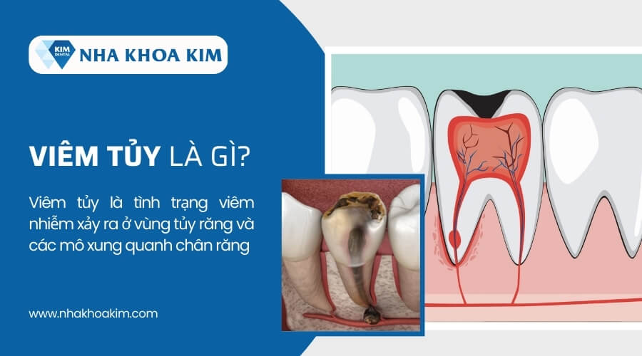 Viêm tủy là gì?