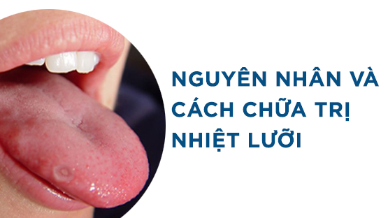 Nhiệt lưỡi: Nguyên nhân, hình ảnh và cách chữa trị