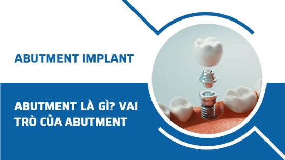 Abutment là gì? Vai trò của Abutment Implant trong cấy ghép