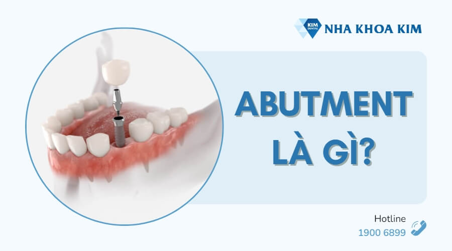 Abutment là gì?
