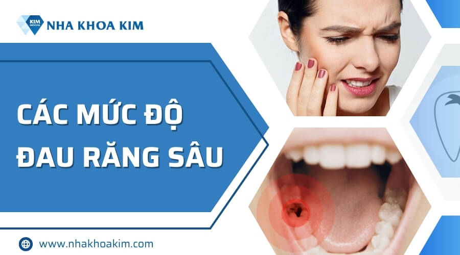 Nhận biết các mức độ đau răng sâu