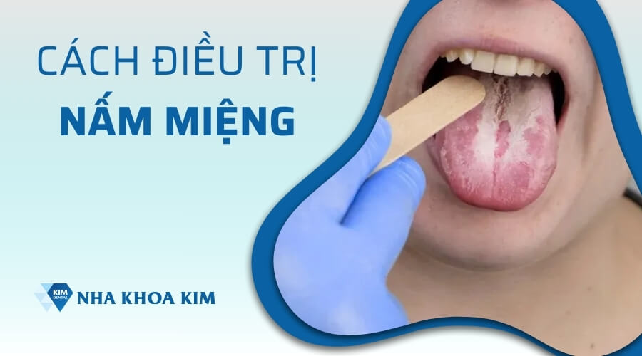 Phương pháp điều trị nấm miệng