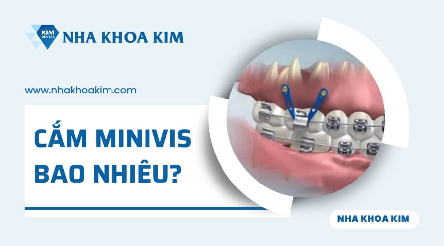 Cắm minivis niềng răng giá bao nhiêu?