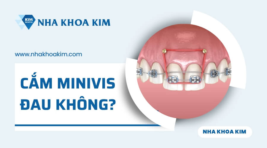 Cắm minivis có đau không?