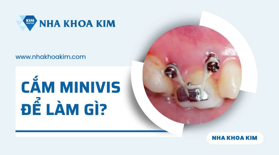 Cắm minivis để làm gì?