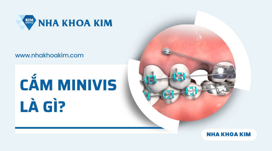Cắm minivis là gì?