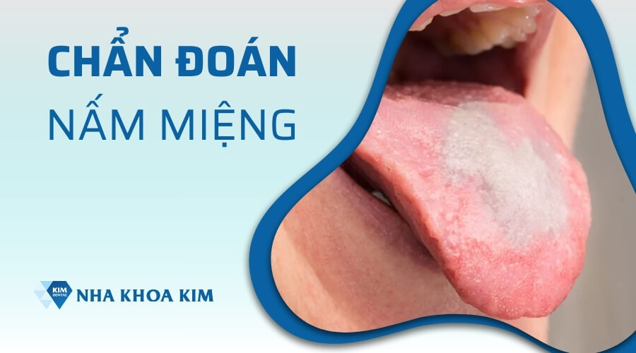 Phương pháp chẩn đoán bệnh nấm miệng