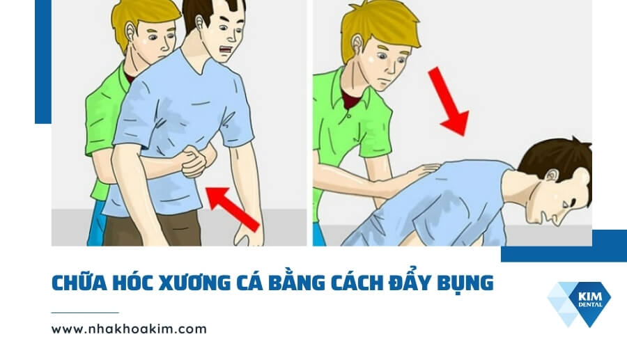 Chữa hóc xương cá bằng Heimlich (đẩy bụng)