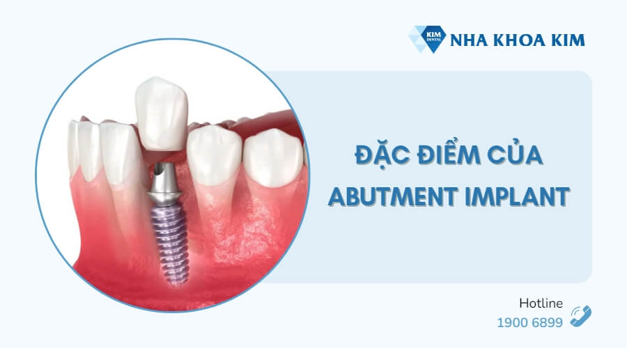 Đặc điểm của Abutment trong cấy ghép Implant