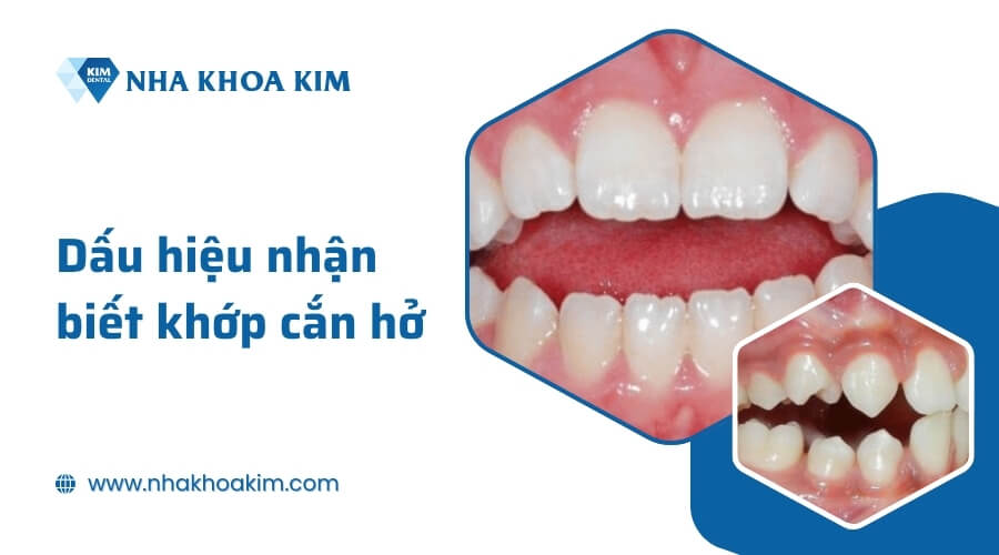 Dấu hiệu nhận biết khớp cắn bị hở
