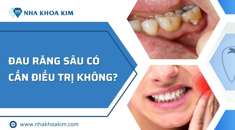 Đau răng sâu có cần phải điều trị không?
