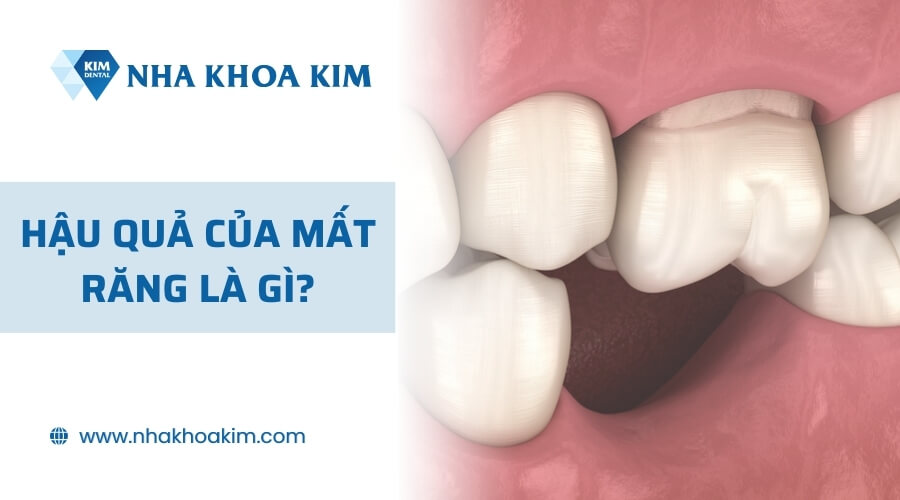 Hậu quả của mất răng là gì?