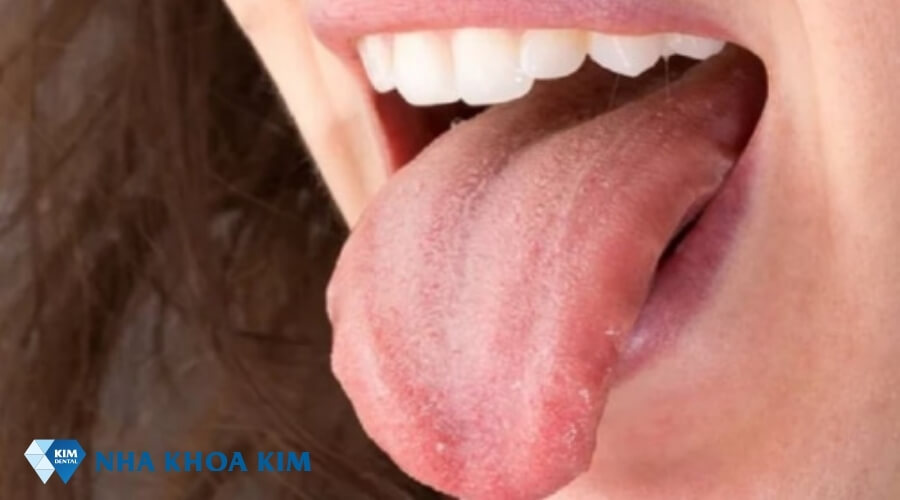 Hình ảnh viêm lưỡi giai đoạn giảm sưng