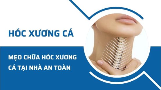 Mẹo chữa hóc xương cá ở cổ họng tại nhà an toàn