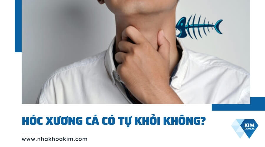 Hóc xương cá có tự khỏi không?