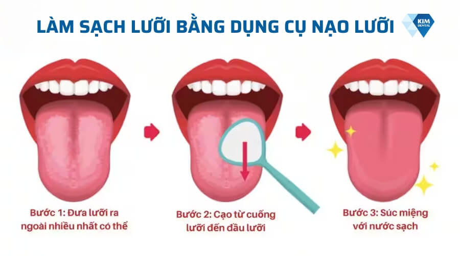 Cách làm sạch lưỡi bằng dụng cụ nạo lưỡi