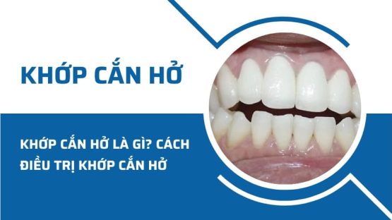 Khớp cắn hở là gì? Cách điều trị khớp cắn hở