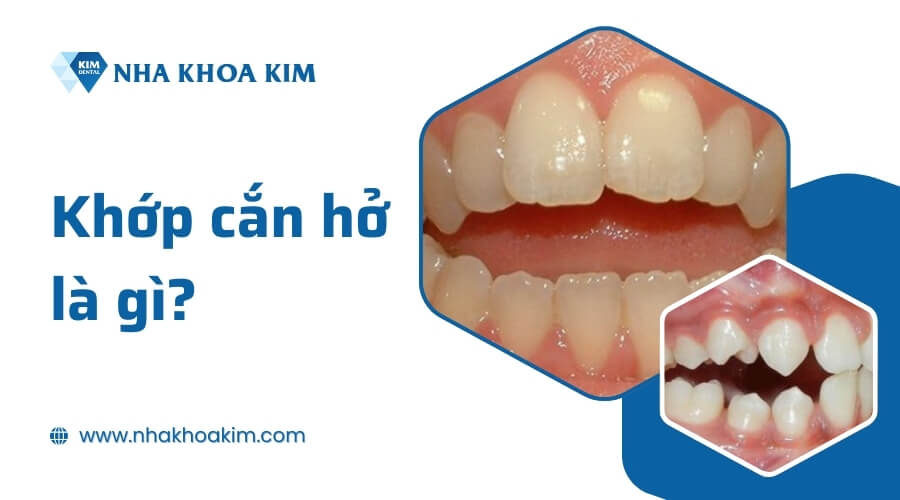 Khớp cắn hở là gì?